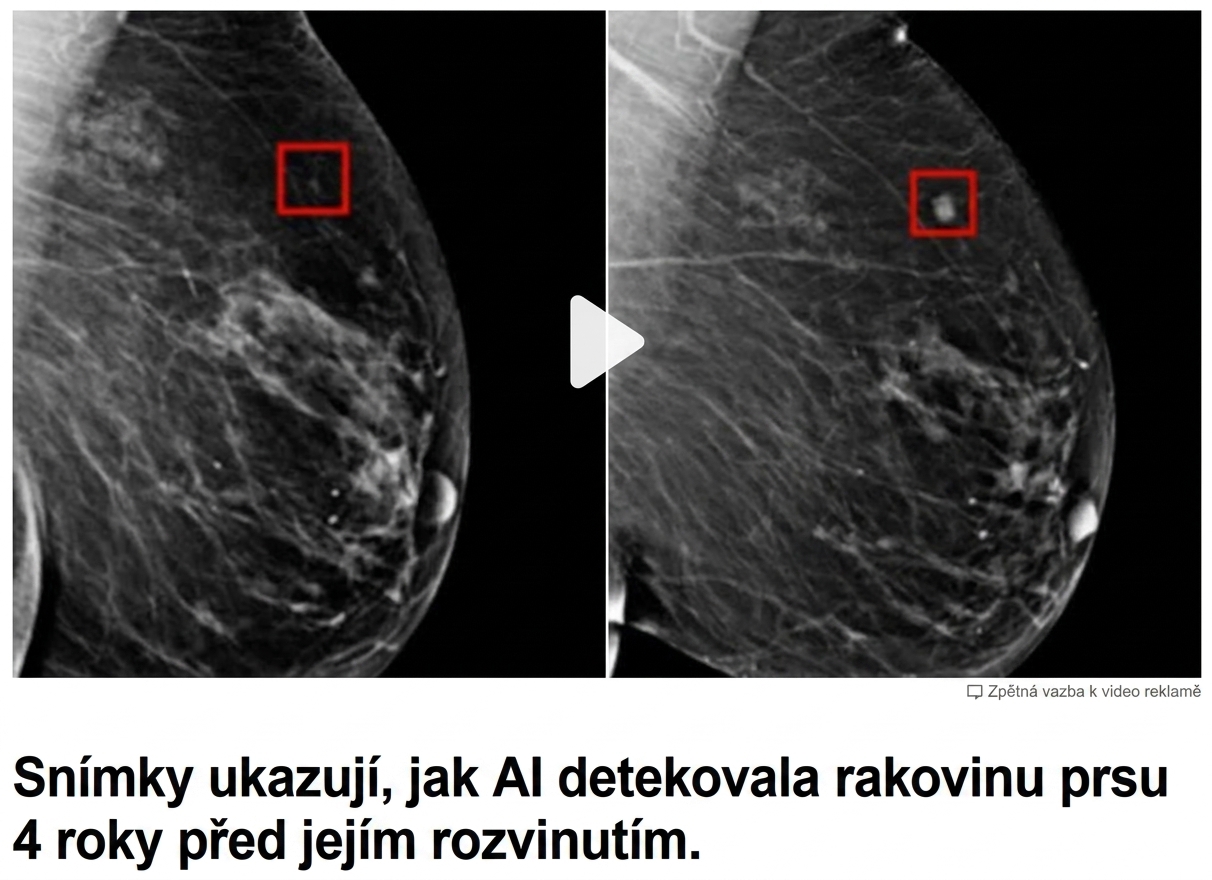 Rentgenový snímek prsu se dvěma nádory v různých stadiích.