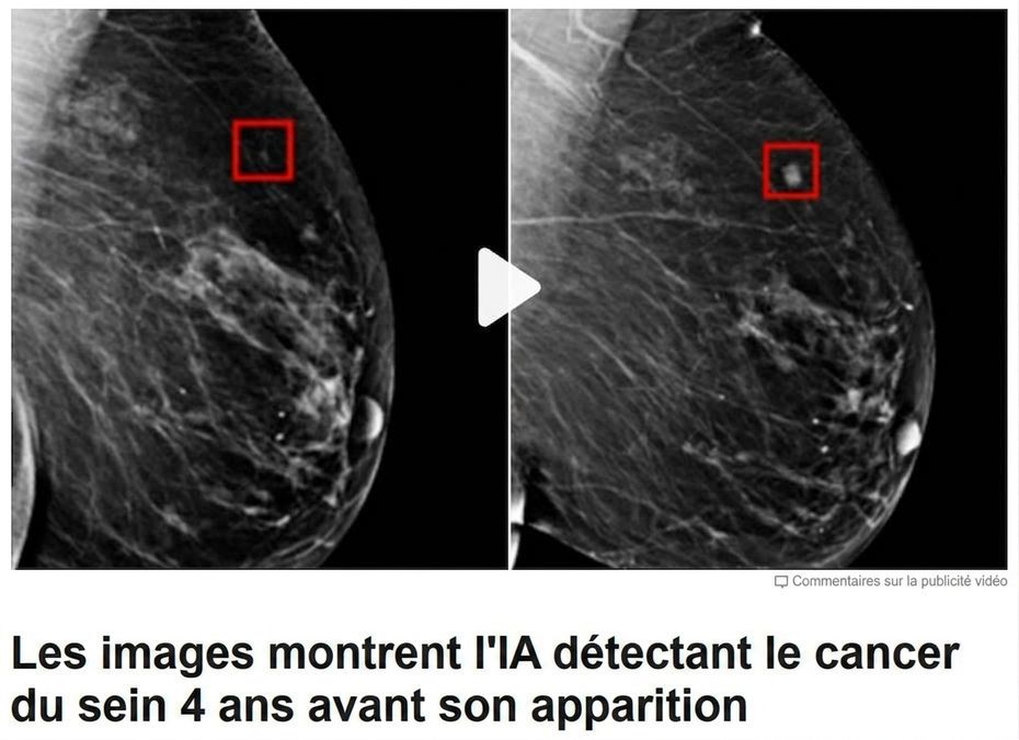 Image d'une mammographie avec deux tumeurs à différents stades de croissance