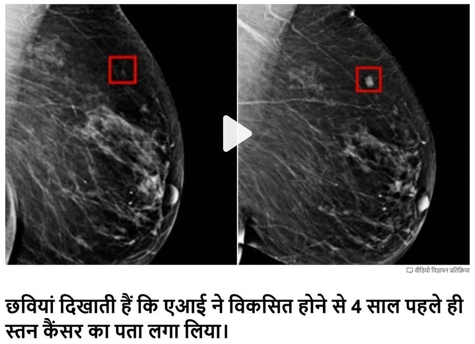 दो अलग चरणों के ट्यूमर के साथ स्तन एक्स-रे छवि
