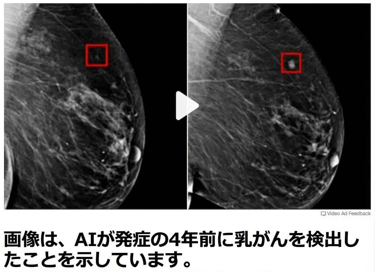 異なる進行度の腫瘍が2つ写る乳房X線画像