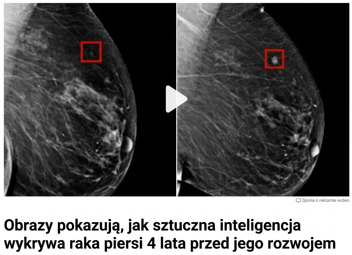 Zdjęcie rentgenowskie piersi z dwoma guzami na różnych etapach wzrostu