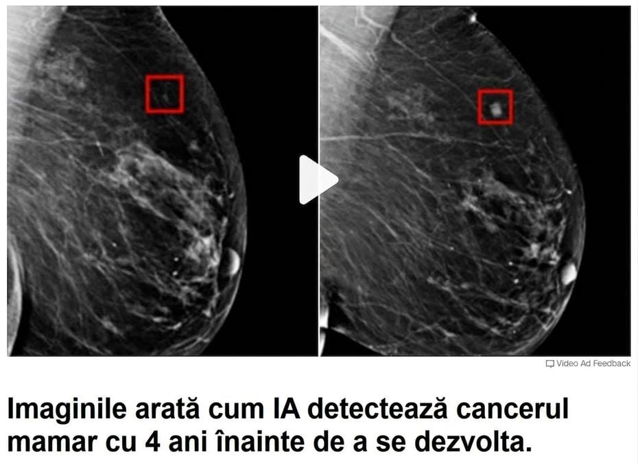 Radiografie mamară cu două tumori în stadii diferite de creștere