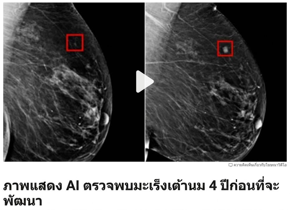 ภาพเอกซเรย์เต้านมที่แสดงเนื้องอก 2 จุดในระยะต่างกัน