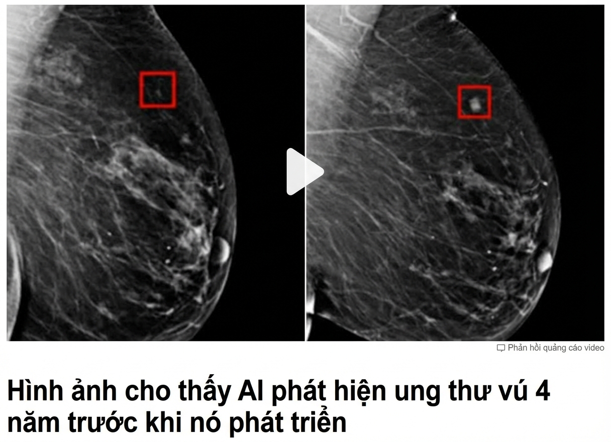 Ảnh X-quang vú với hai khối u ở các giai đoạn khác nhau
