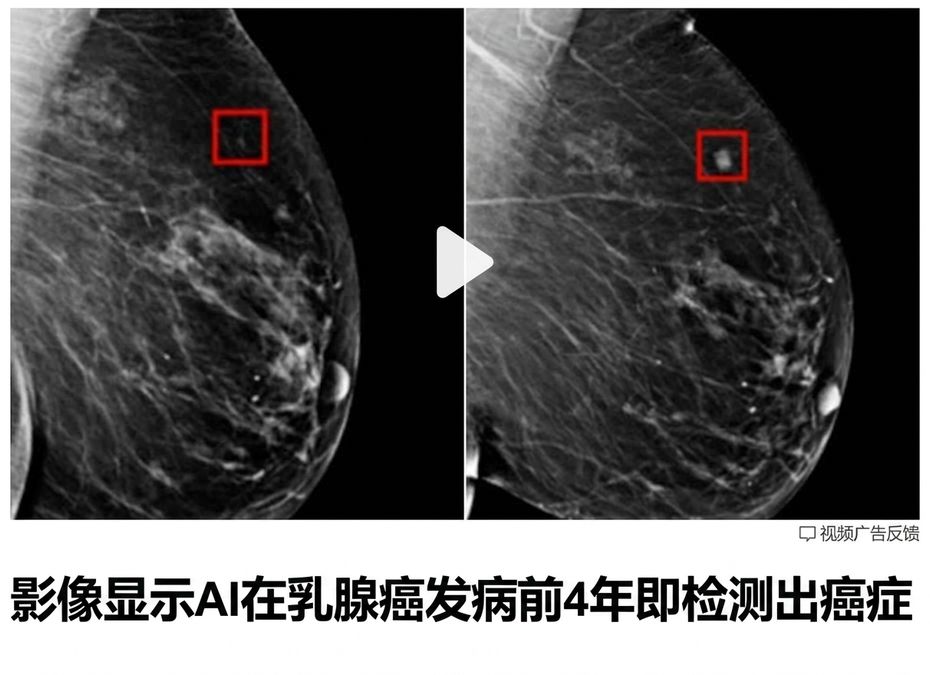 一张乳腺X光片，显示两个不同生长阶段的肿瘤