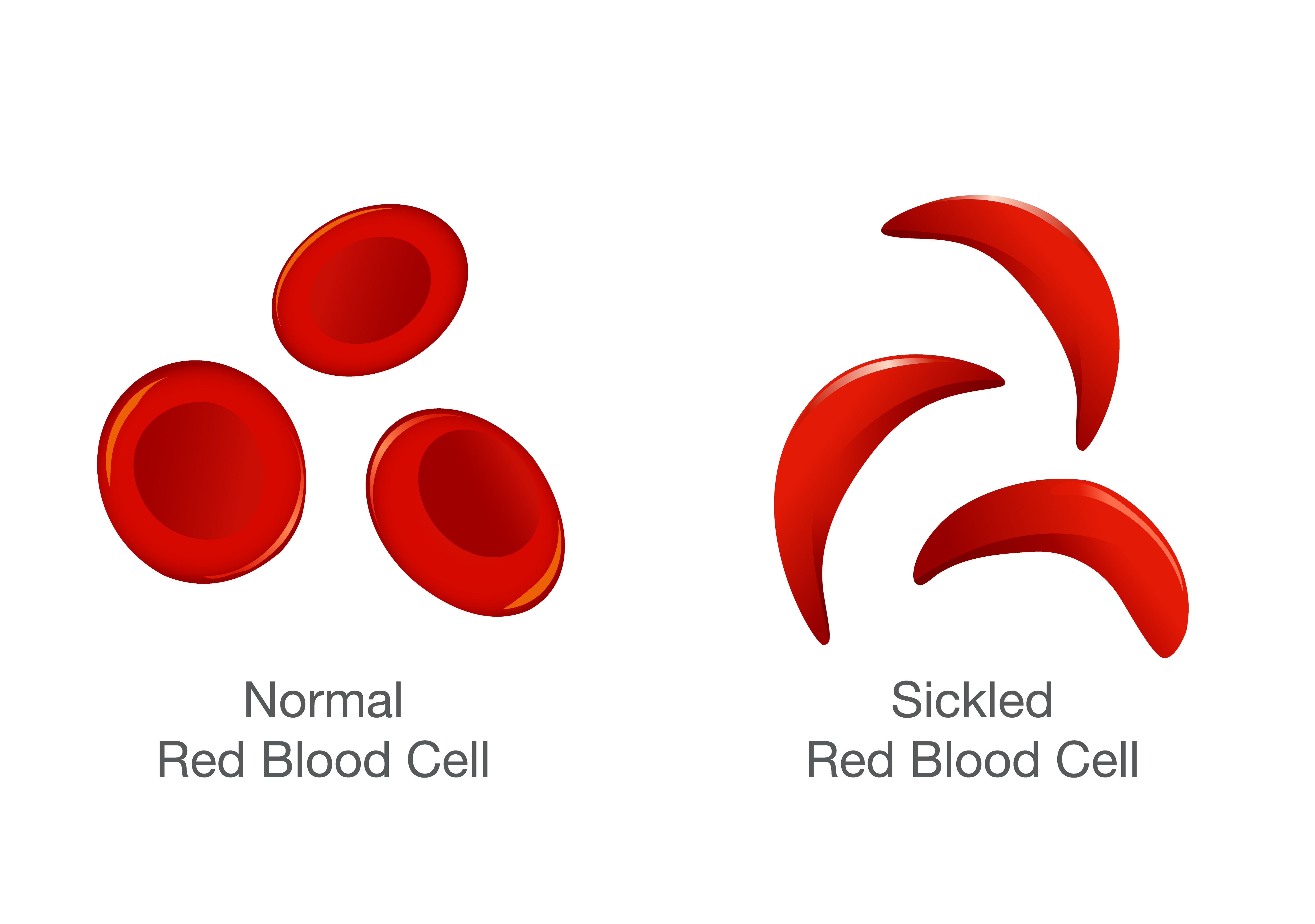 sickle cells
