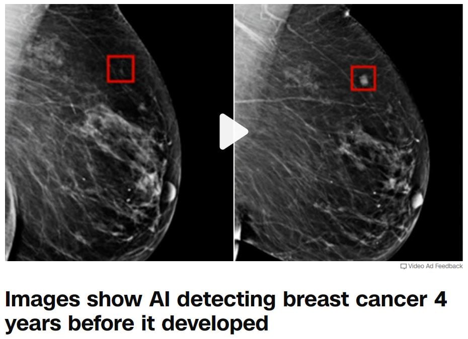 A breast x-ray image with two tumors at different stages of growth