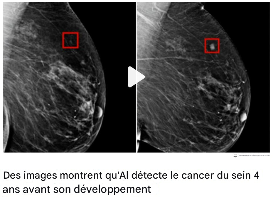 Radiographie d’un sein avec deux tumeurs à différents stades de croissance