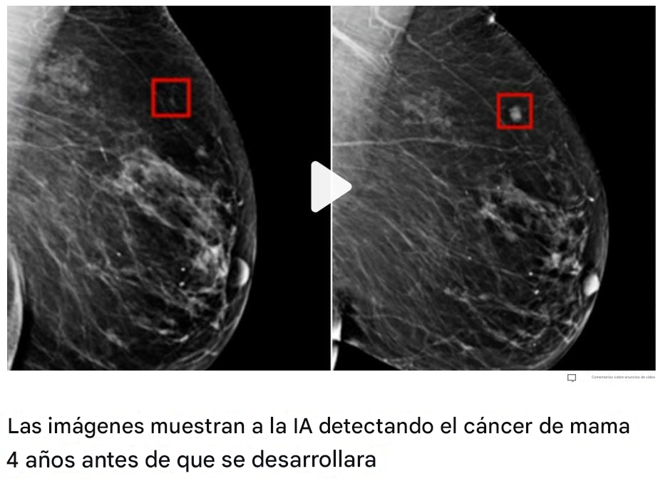 Una radiografía de mama con dos tumores en diferentes fases de crecimiento.