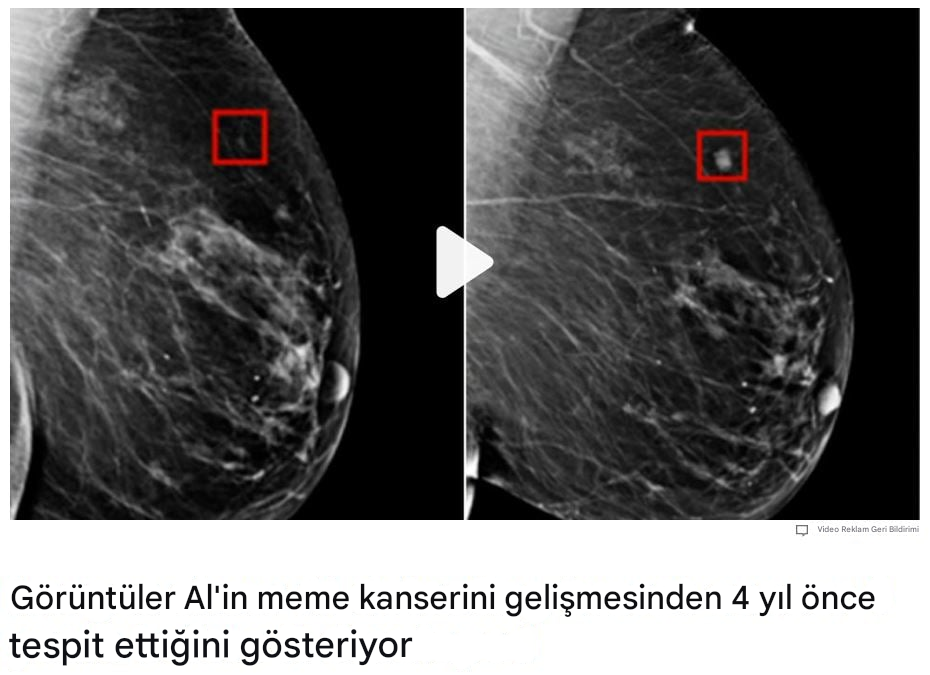 Farklı büyüme aşamalarında iki tümör içeren bir meme röntgeni görüntüsü