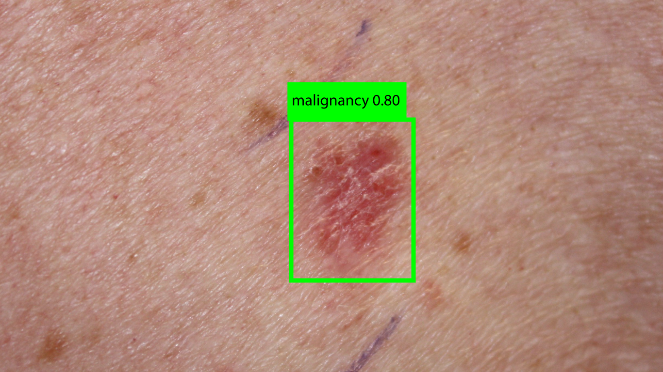 picture of skin lesion